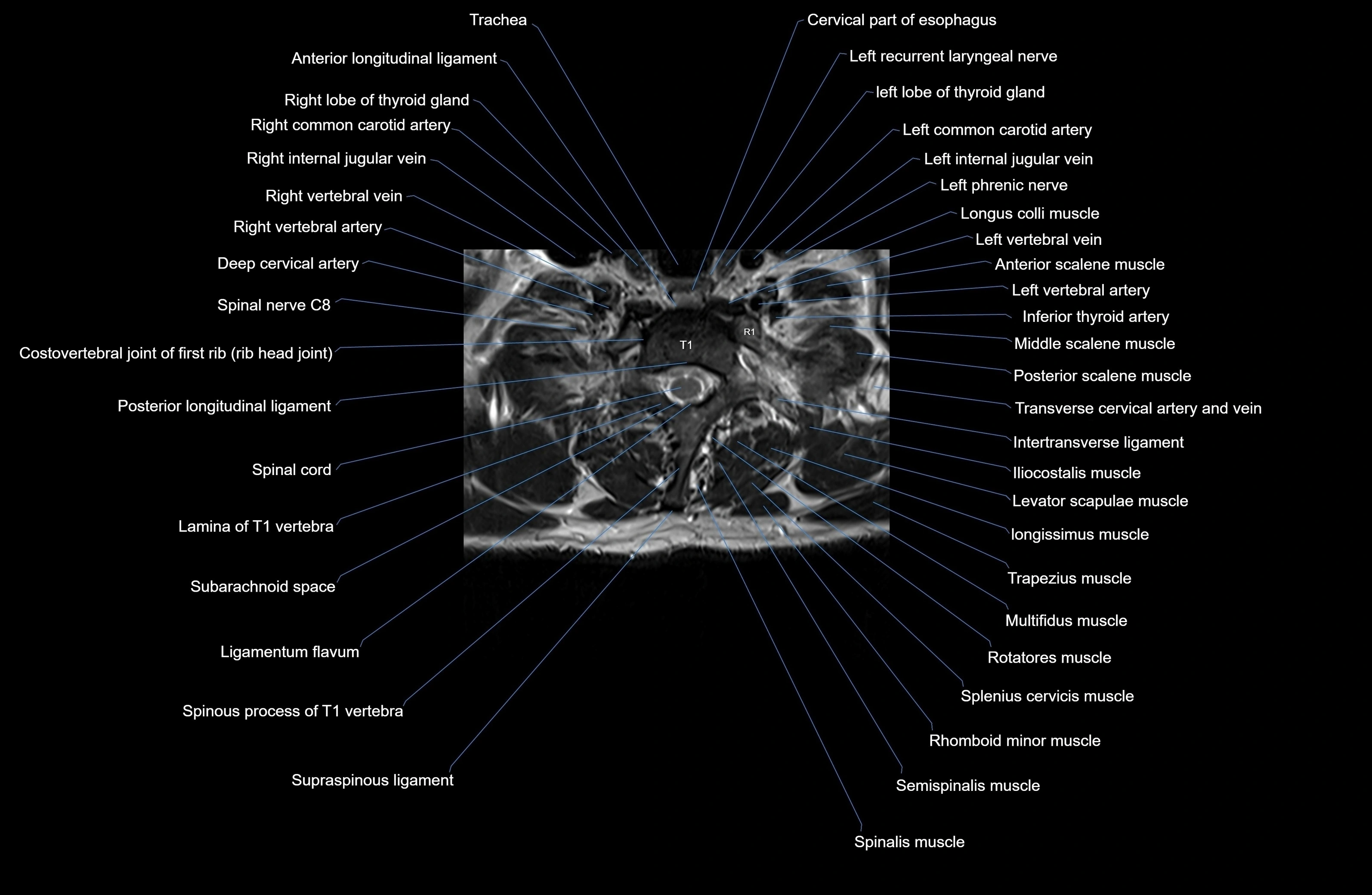 MRI thoracic spine axial  cross sectional anatomy 3T radiology  image-img-00001-00008.webp